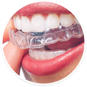 cosmetic_dentistry_teeth_straightening_invisaligns - cheadle dentist