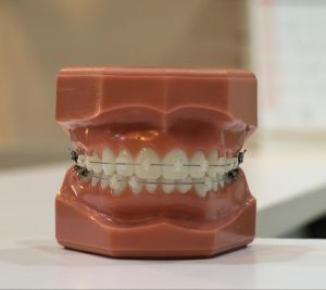 metal_braces