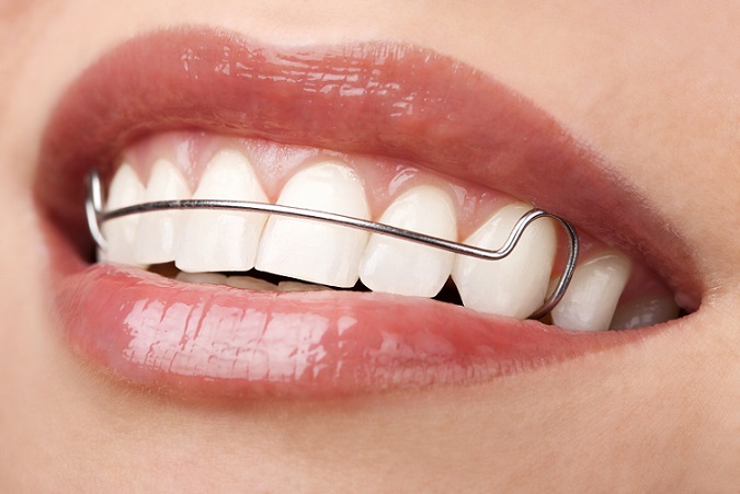 Removable Braces Invisalign