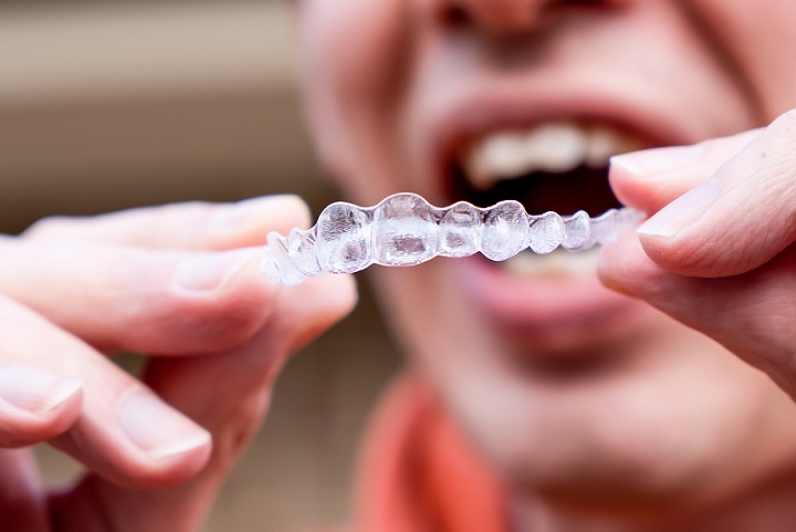 clear braces - Benefits of Invisalign