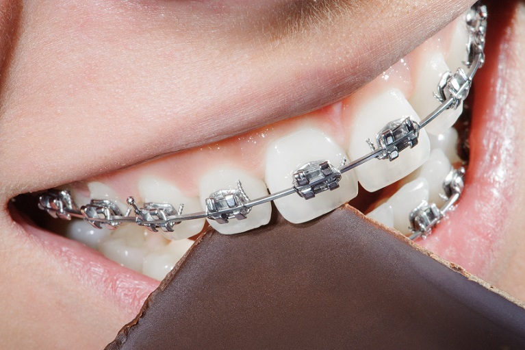 eating chocolate with braces