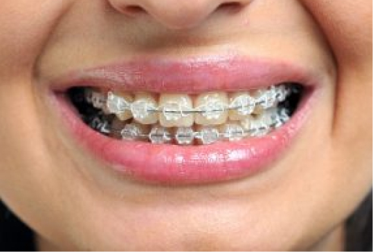 Ceramic Braces Manchester, Bring Back Your Smile