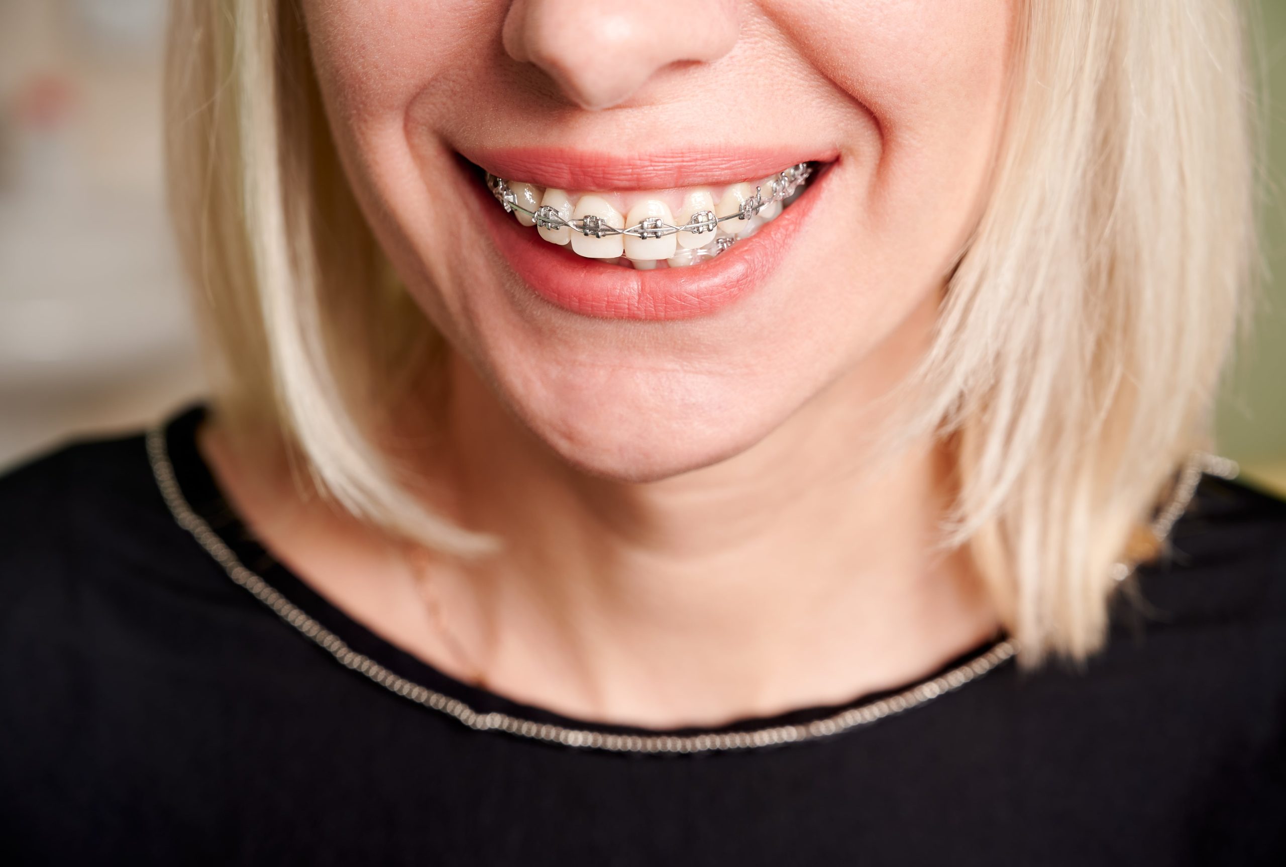 woman wearing metal braces as an adult