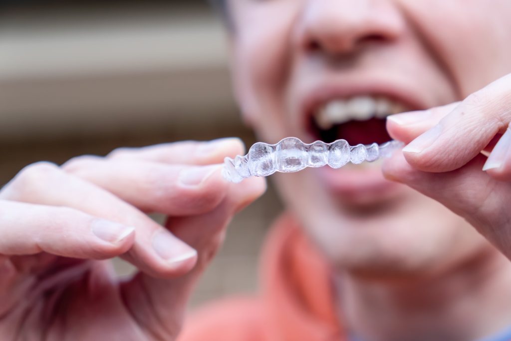 man putting on invisible braces as an adult