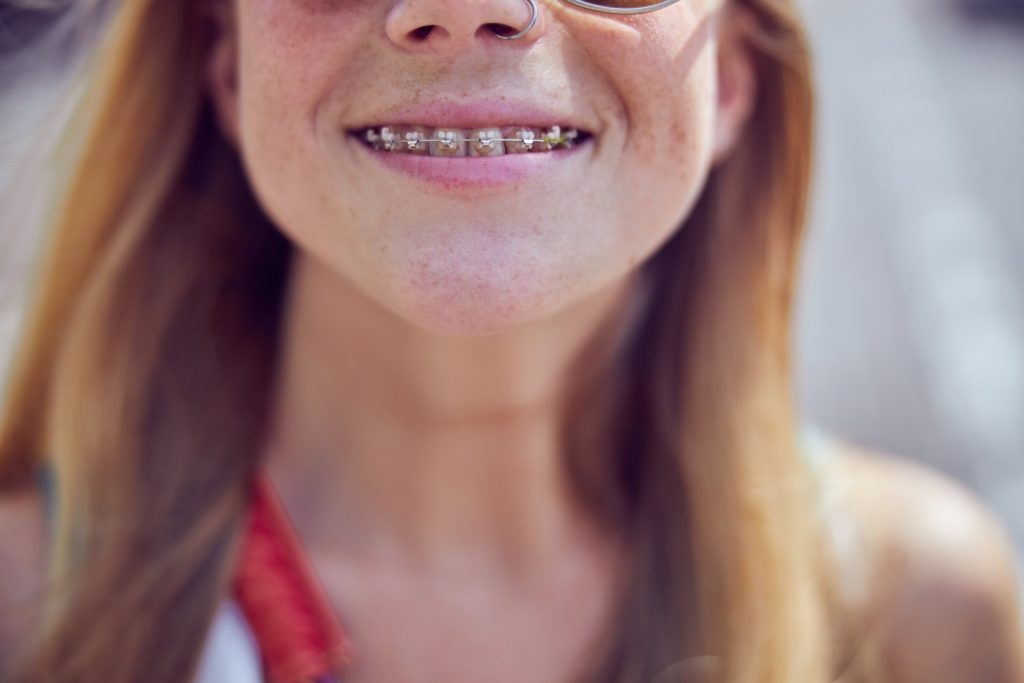woman wearing braces - a type of orthodontic appliances