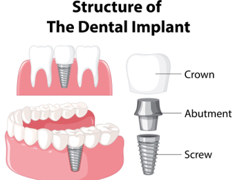 single implant