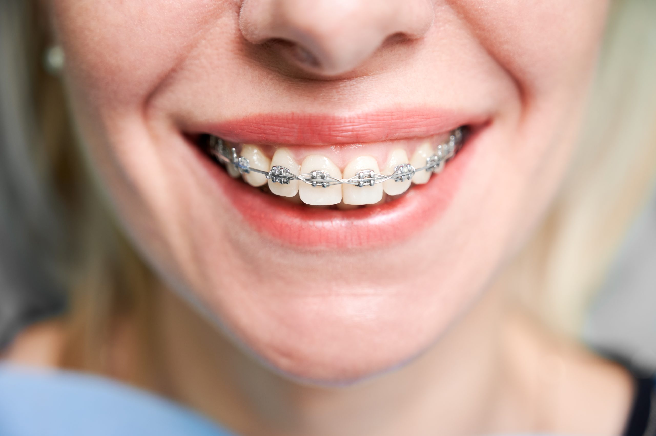 Fixed Braces, Orthodontics Treatment