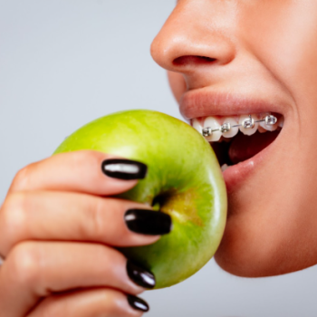 Foods to Eat and Avoid with Braces 