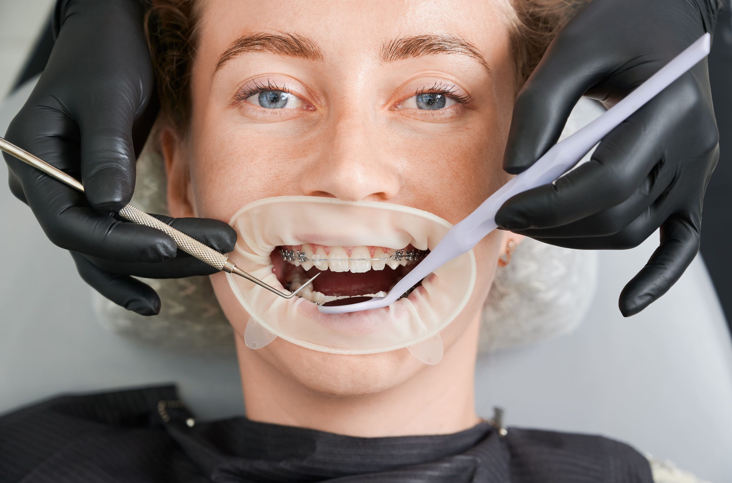 how long does teeth straightening takes